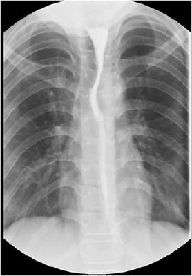 Case report: Peroral endoscopic myotomy for acute pandysautonomia-associated distal esophageal spasm in a child